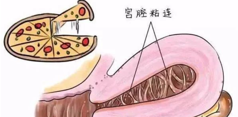 宫腔粘连对怀孕有多少影响？.jpg